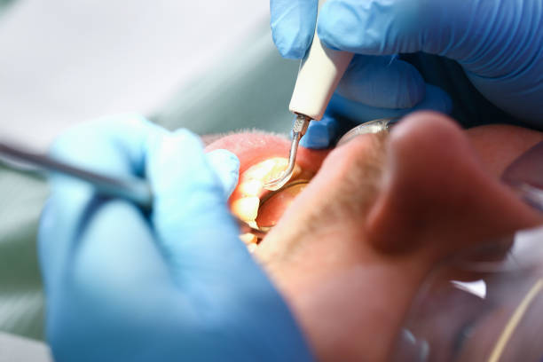Teeth Whitening in MD